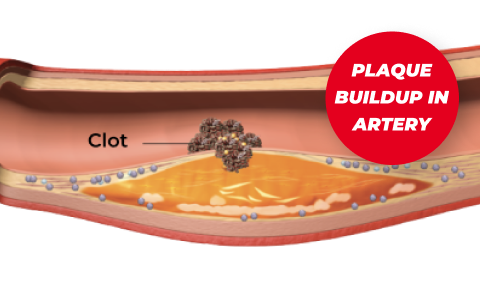 Plaque buildup in artery
