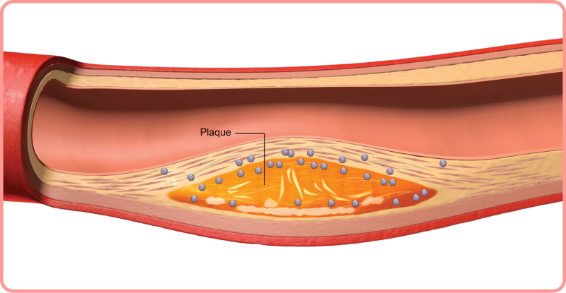 interactive artery: blood flow reduction in artery