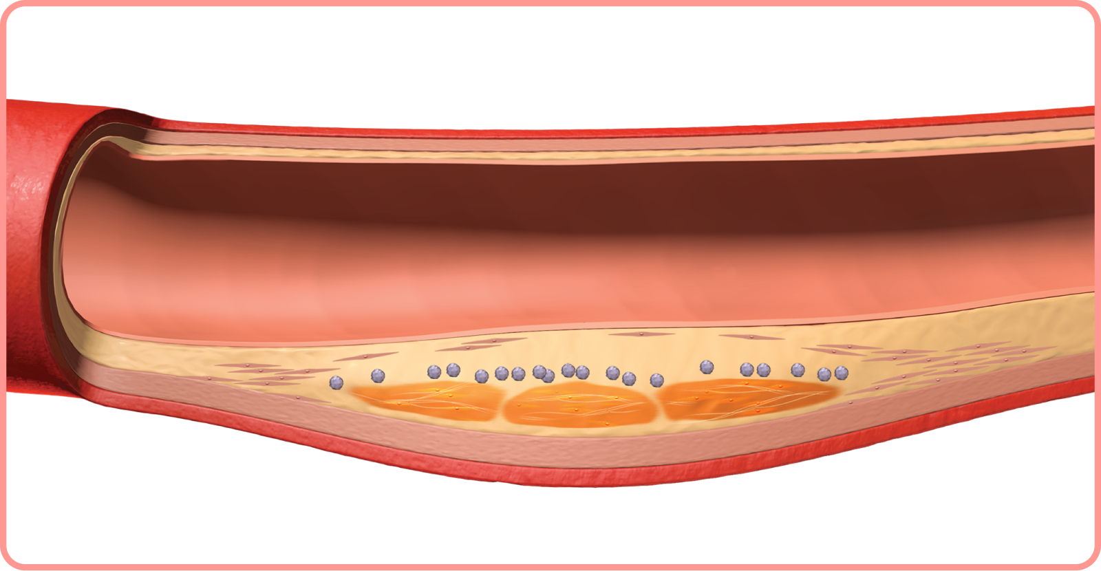 interactive artery: plaque forming in fatty deposits in artery