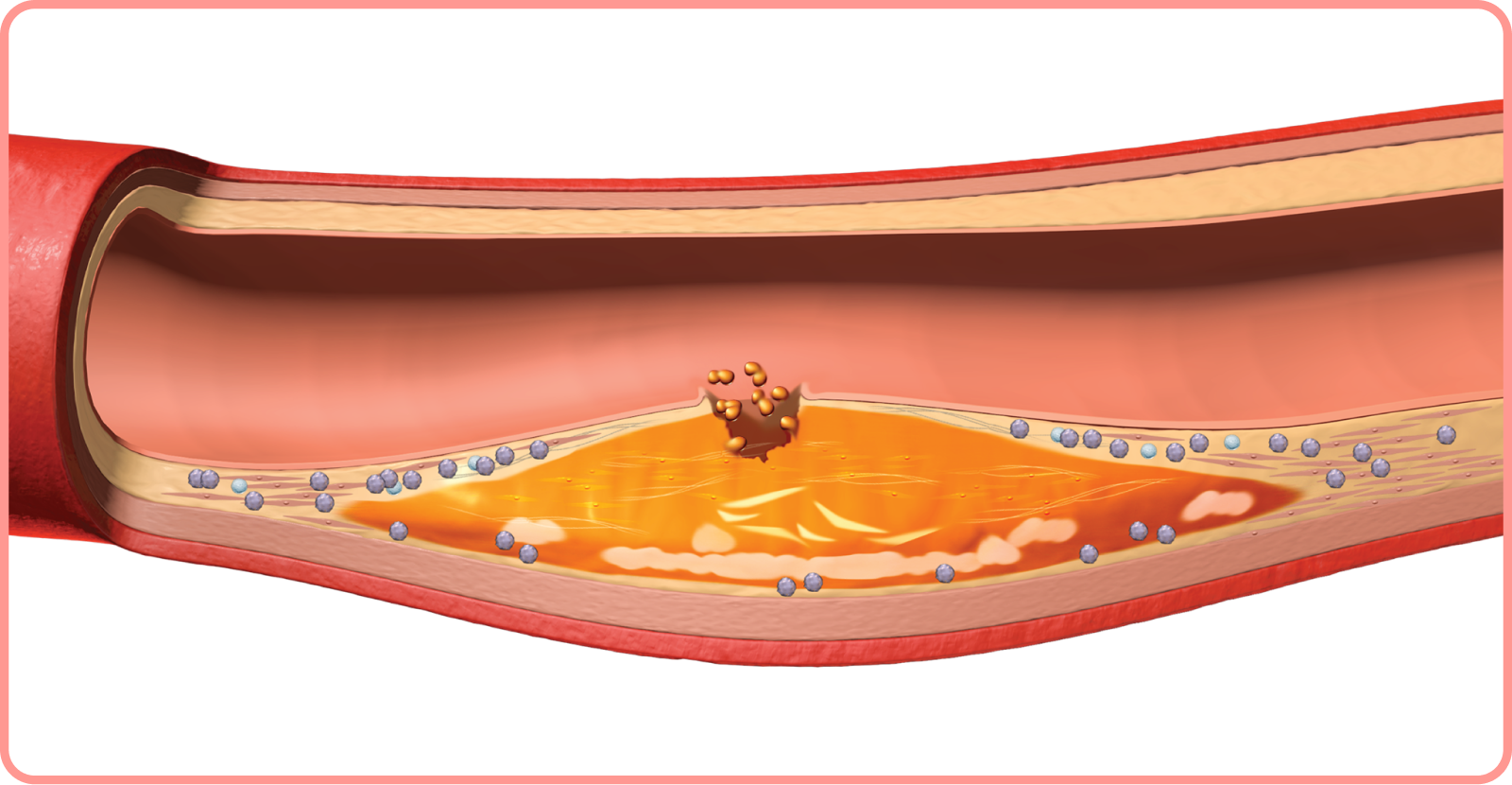 interactive artery: plaque rupture in artery