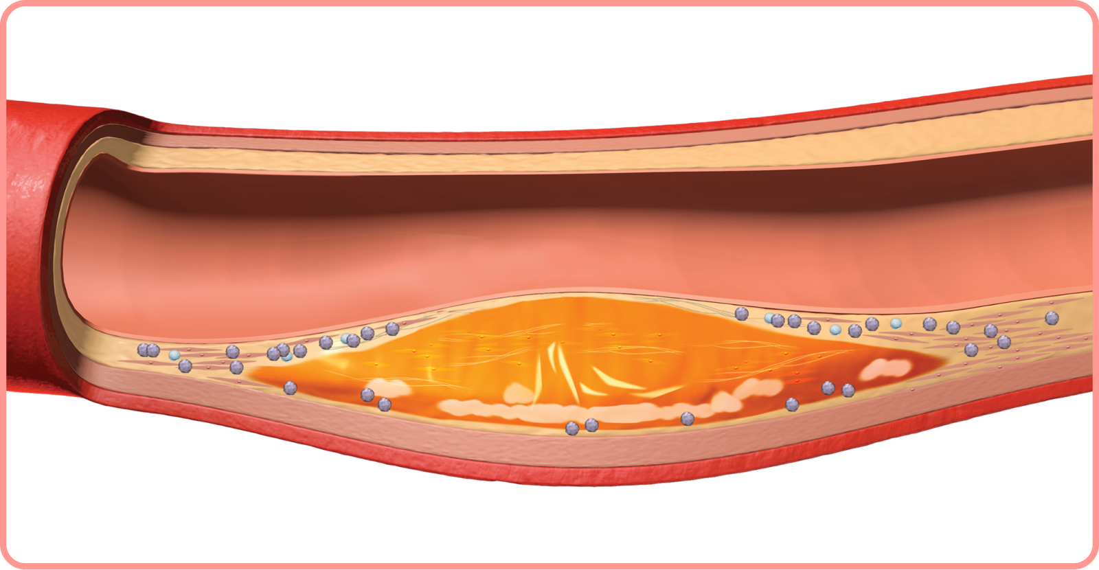interactive artery: plaque growth and inflammation in artery