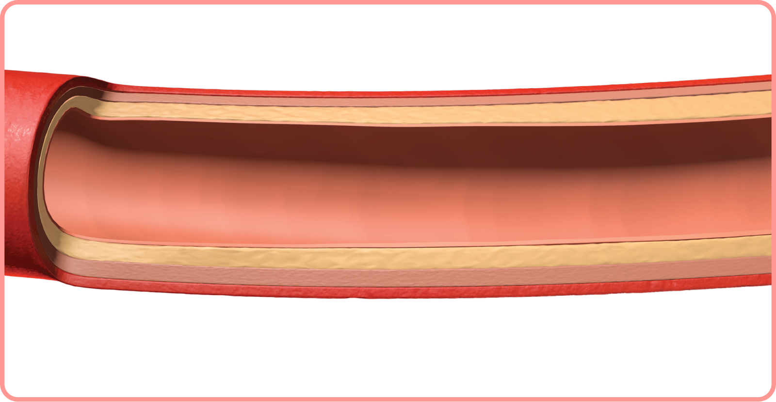 interactive artery: cholesterol build up in artery
