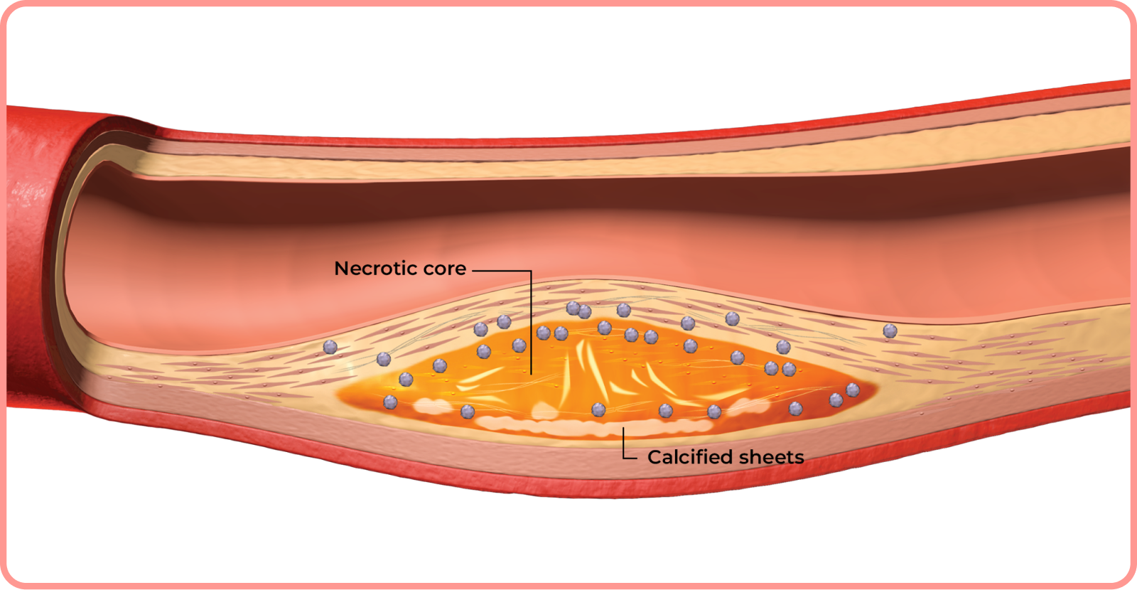interactive artery: necrotic core and calcified sheets in artery