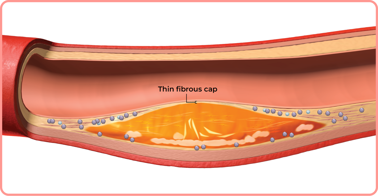 interactive artery: thin fibrous cap in artery
