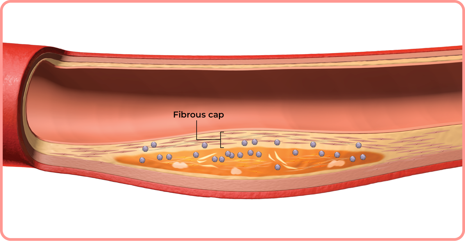 interactive artery: fibrous cap in artery