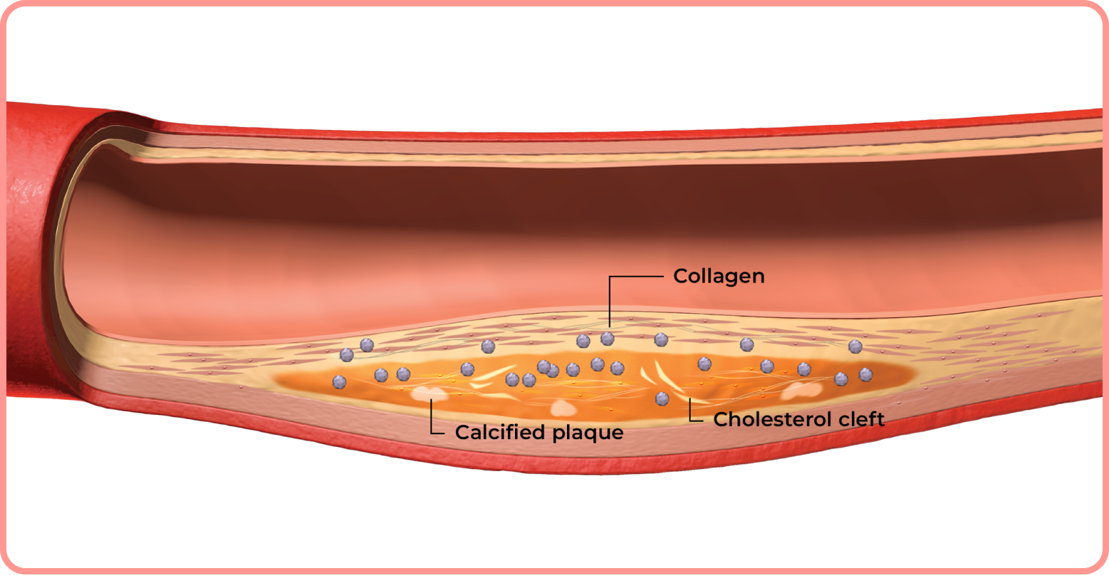 interactive artery: collagen, calcified plaque, and cholesterol cleft buildup