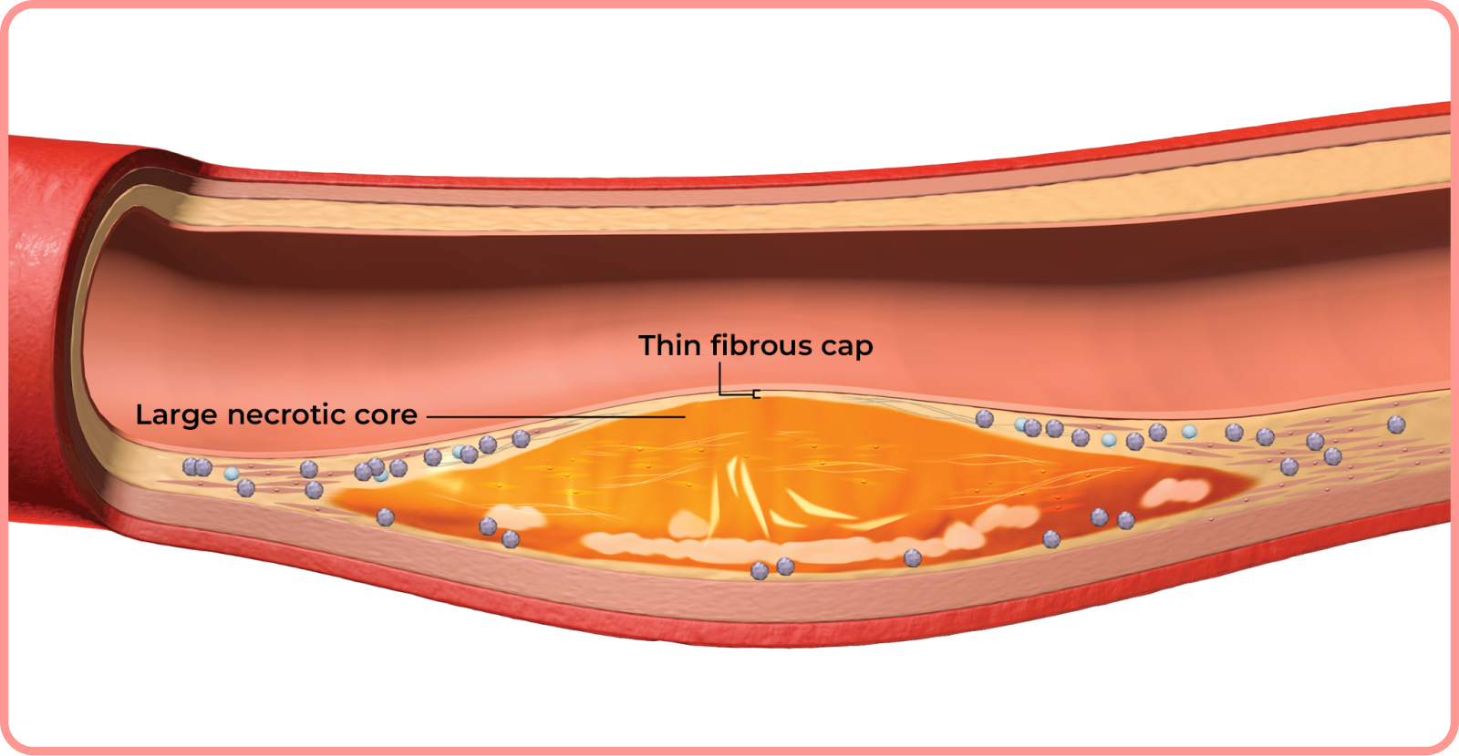 interactive artery: thin fibrous cap and large necrotic core in artery