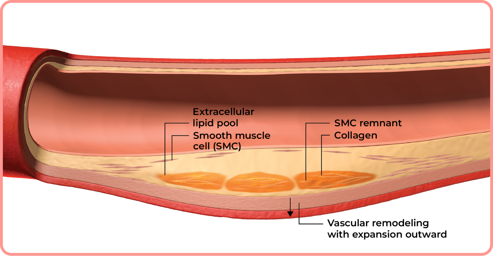 interactive artery: fatty deposits forming in artery