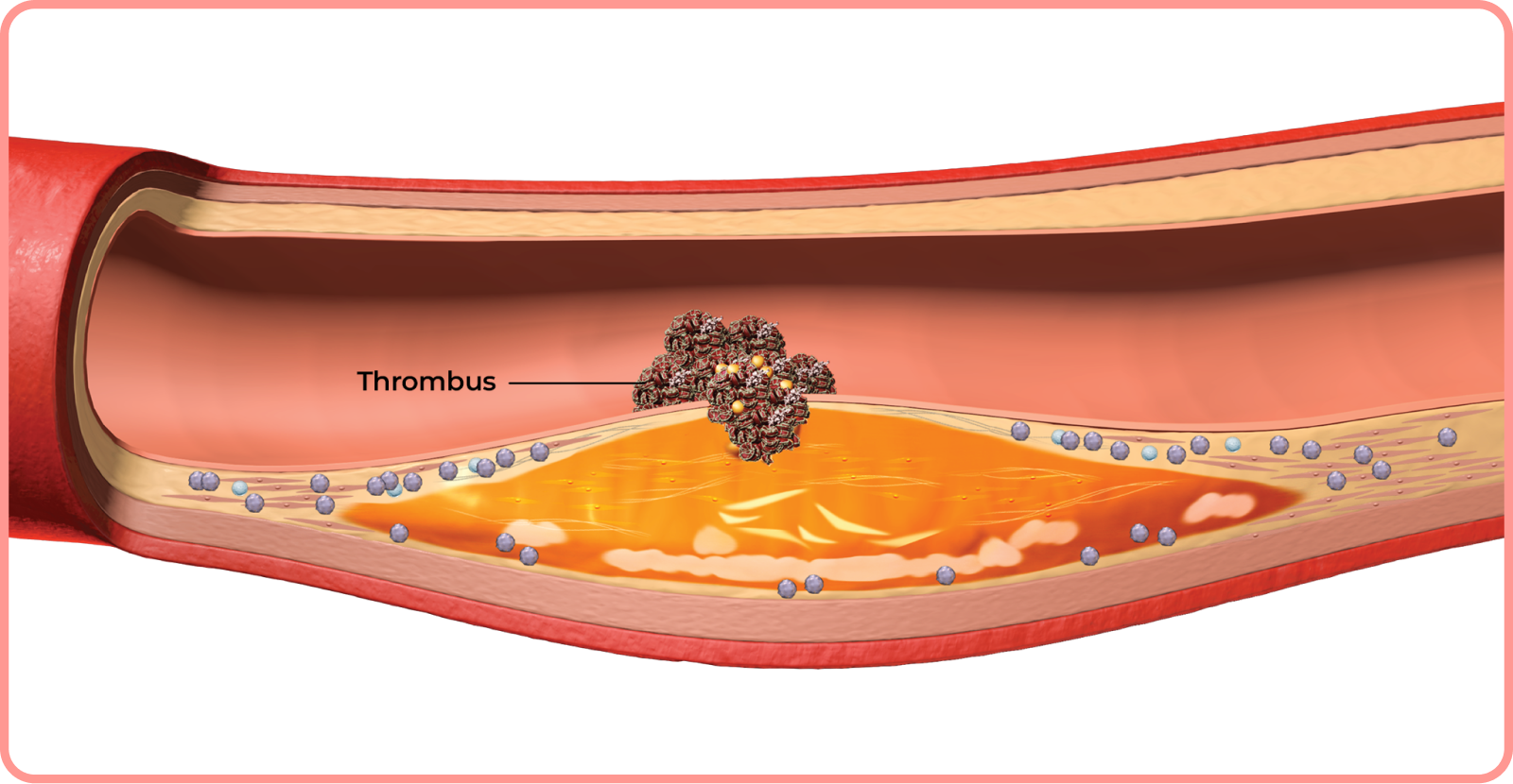 interactive artery: thrombus in artery