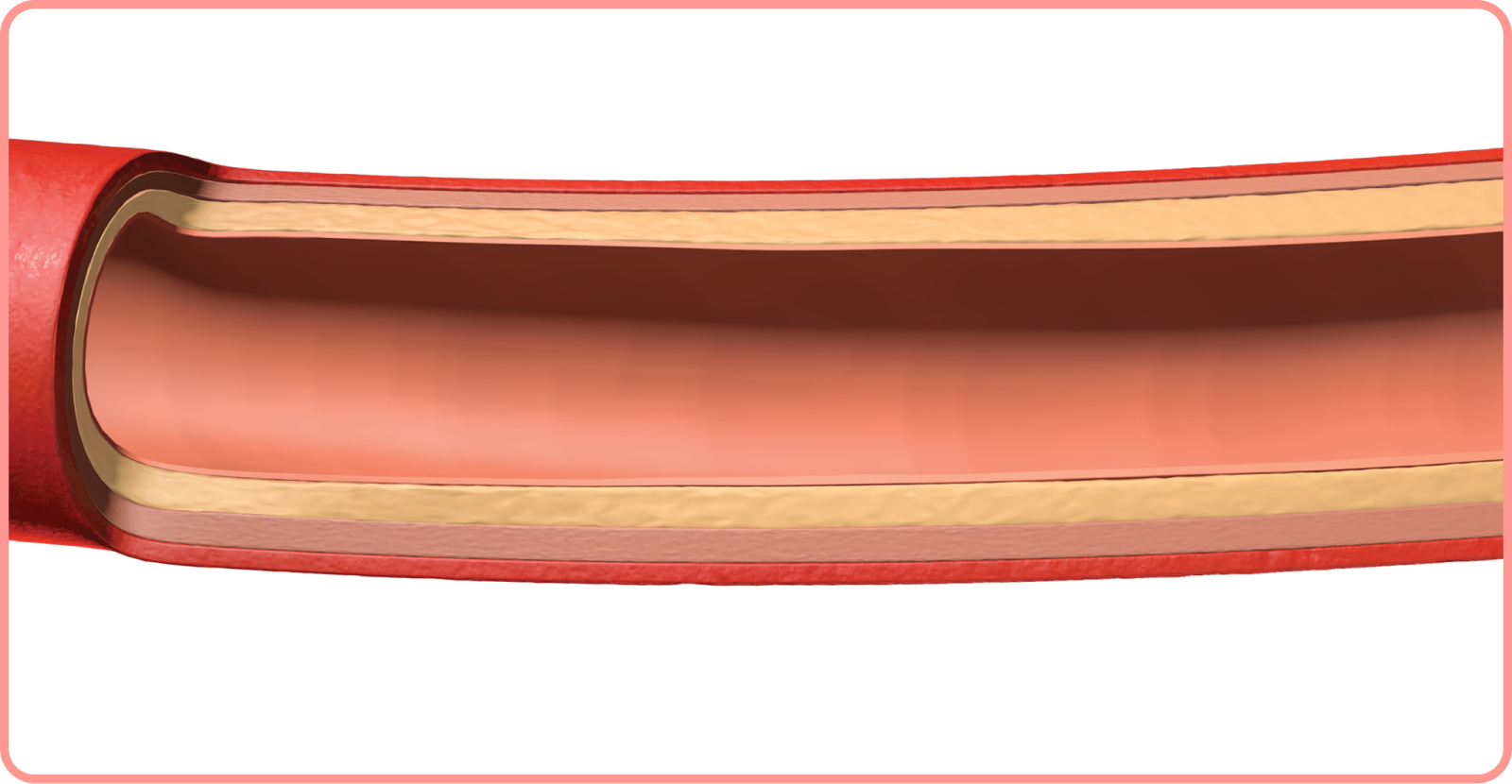 interactive artery: cholesterol build up in artery